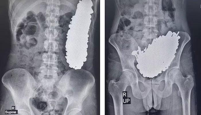 ڈاکٹروں نے مریض کے معدے سے 452 دھاتی اشیاء نکال لیں